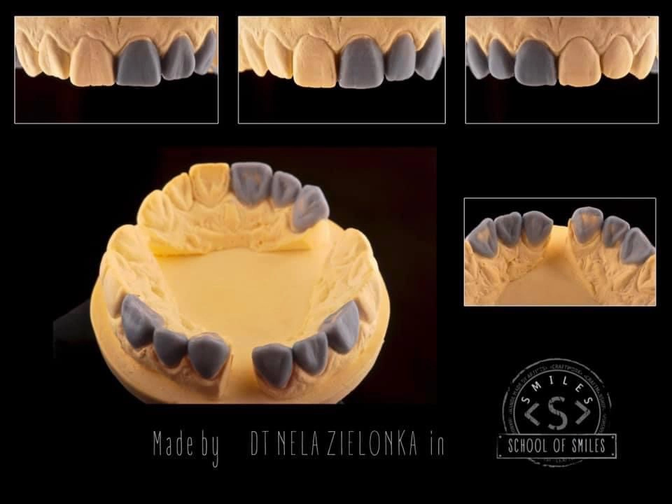 Woskowa rekonstrukcja zębów przednich i bocznych na modelu diagnostycznym szczęki, przygotowana do planowania leczenia protetycznego.