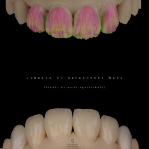 VENEERS ON REFRACTORY MASS - licówki na masie ogniotrwałej