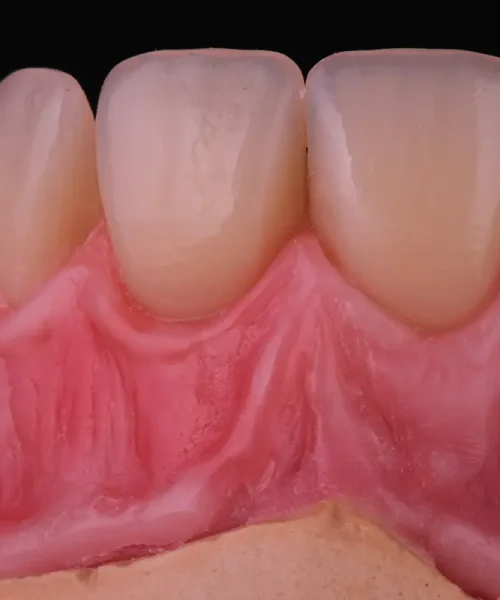 Zbliżenie na realistyczną strukturę dziąsła i zębów w protezie stomatologicznej – indywidualne modelowanie, cieniowanie i odwzorowanie anatomicznych detali tkanki miękkiej.