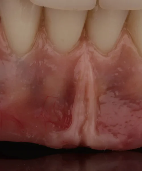 Anatomiczna proteza z pełnym wybarwieniem dziąseł – zaawansowane modelowanie tkanek miękkich i doskonała adaptacja zębów.