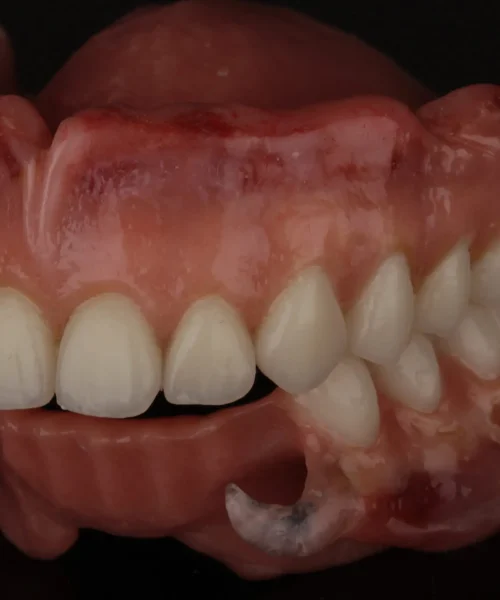 Proteza wykonana techniką ręczną – artystyczna praca technika dentystycznego z dbałością o detale i funkcjonalność.